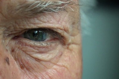 Göz kapağı düşüklüğü (Pitozis) neden olur? İşte tedavi yöntemleri!