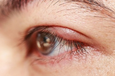 Blefarit (Göz kapağı iltihabı) neden olur? Blefarit belirtileri ve tedavisi