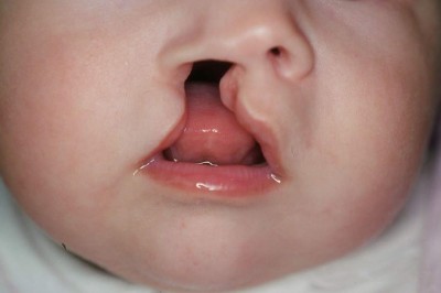 Yarık dudak (tavşan dudak) hastalığı nedir neden olur? Yarık dudak hastalığı tedavisi