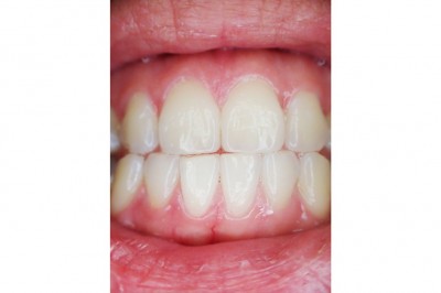 Diş kisti nedir neden olur? Diş kisti belirtileri ve tedavisi